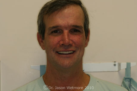 Complete Dentures, false teeth