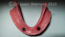 implant denture
