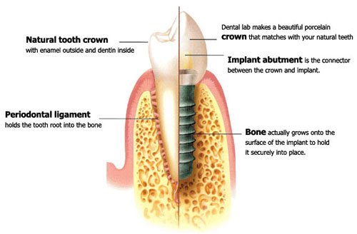 Dental Implant