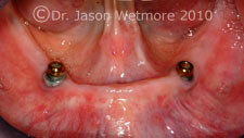 Dental implants with locator denture attachments