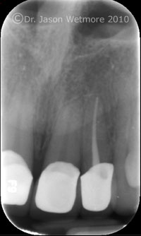 root canal 