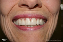 Veneers After
