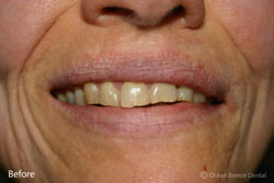 teeth before Veneers